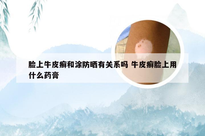 脸上牛皮癣和涂防晒有关系吗 牛皮癣脸上用什么药膏