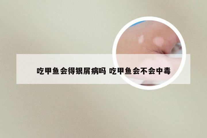 吃甲鱼会得银屑病吗 吃甲鱼会不会中毒