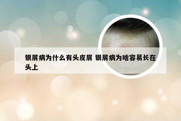 银屑病为什么有头皮屑 银屑病为啥容易长在头上