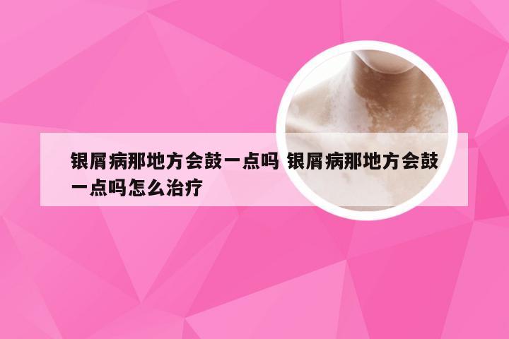 银屑病那地方会鼓一点吗 银屑病那地方会鼓一点吗怎么治疗