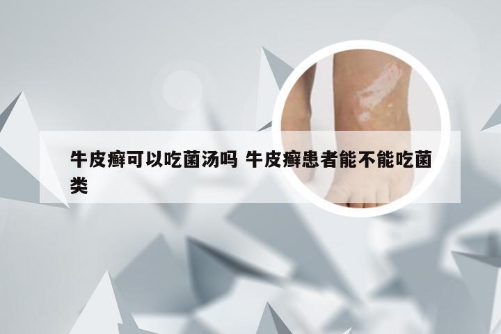 牛皮癣可以吃菌汤吗 牛皮癣患者能不能吃菌类