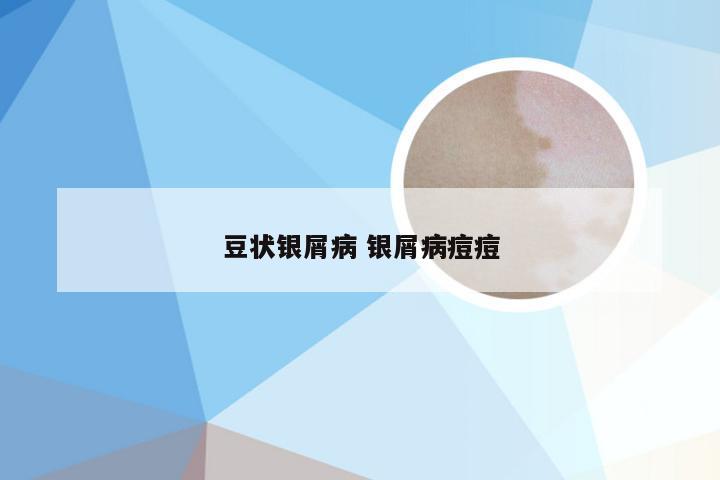 豆状银屑病 银屑病痘痘