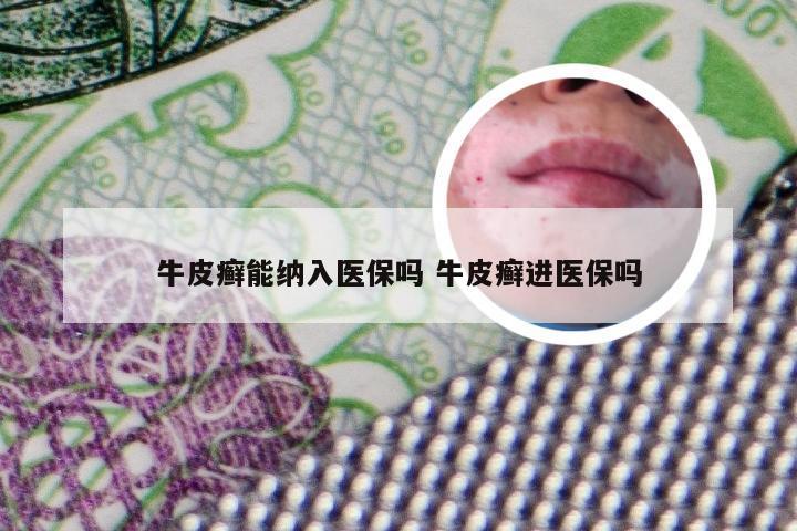 牛皮癣能纳入医保吗 牛皮癣进医保吗