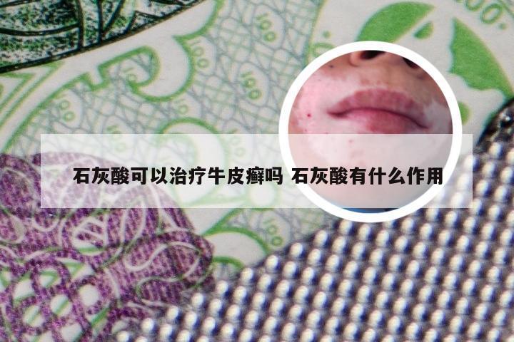 石灰酸可以治疗牛皮癣吗 石灰酸有什么作用