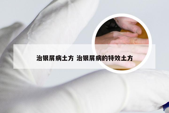 治银屑病土方 治银屑病的特效土方