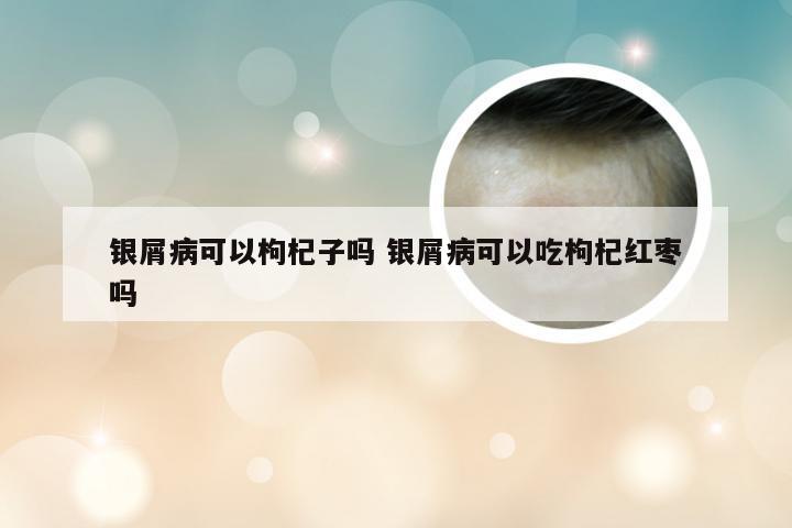 银屑病可以枸杞子吗 银屑病可以吃枸杞红枣吗