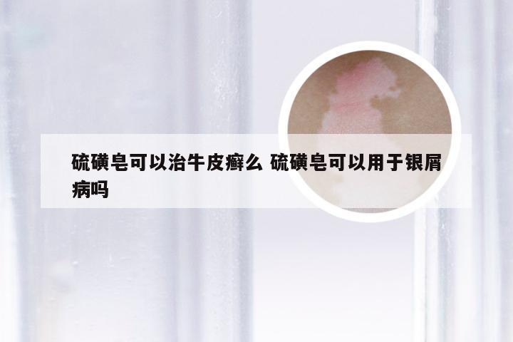硫磺皂可以治牛皮癣么 硫磺皂可以用于银屑病吗