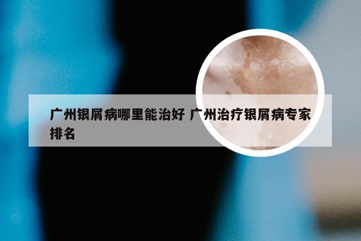广州银屑病哪里能治好 广州治疗银屑病专家排名
