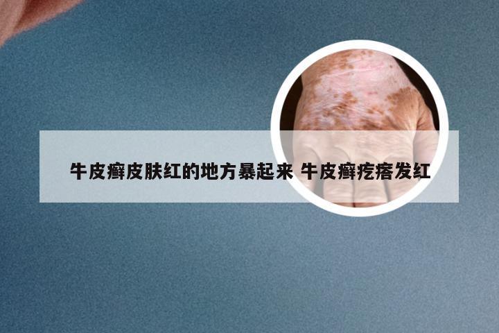 牛皮癣皮肤红的地方暴起来 牛皮癣疙瘩发红