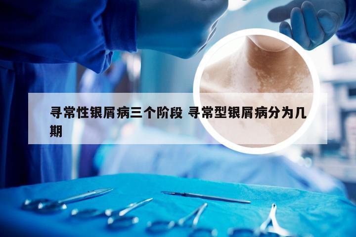 寻常性银屑病三个阶段 寻常型银屑病分为几期