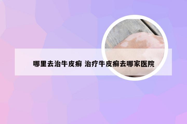 哪里去治牛皮癣 治疗牛皮癣去哪家医院