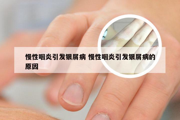 慢性咽炎引发银屑病 慢性咽炎引发银屑病的原因