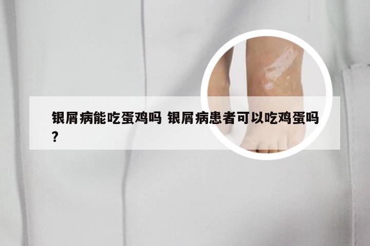 银屑病能吃蛋鸡吗 银屑病患者可以吃鸡蛋吗?