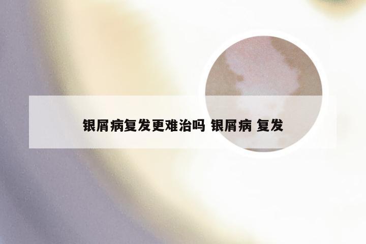 银屑病复发更难治吗 银屑病 复发