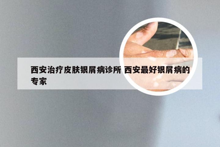 西安治疗皮肤银屑病诊所 西安最好银屑病的专家