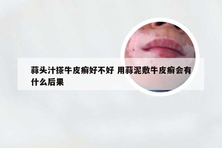 蒜头汁搽牛皮癣好不好 用蒜泥敷牛皮癣会有什么后果