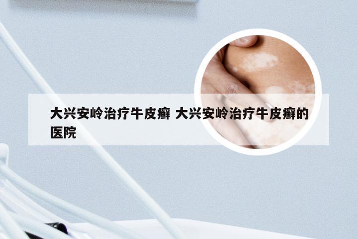 大兴安岭治疗牛皮癣 大兴安岭治疗牛皮癣的医院