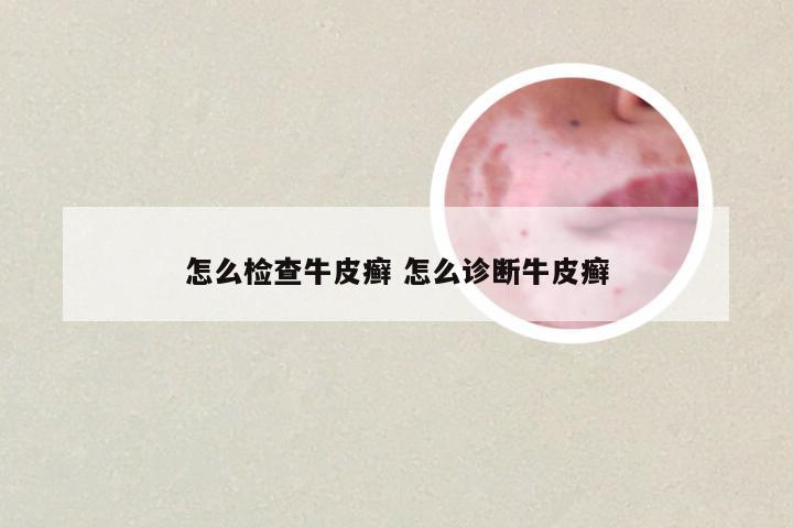 怎么检查牛皮癣 怎么诊断牛皮癣