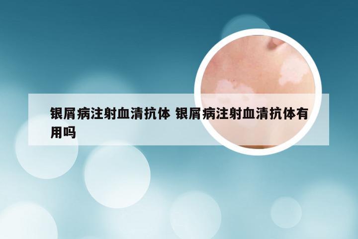 银屑病注射血清抗体 银屑病注射血清抗体有用吗