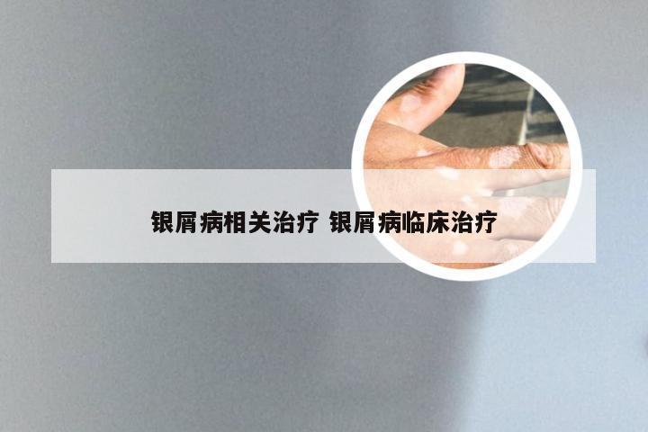 银屑病相关治疗 银屑病临床治疗