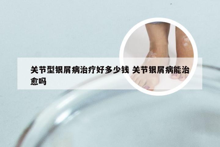 关节型银屑病治疗好多少钱 关节银屑病能治愈吗