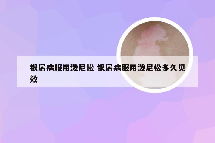 银屑病服用泼尼松 银屑病服用泼尼松多久见效