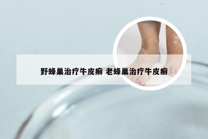野蜂巢治疗牛皮癣 老蜂巢治疗牛皮癣
