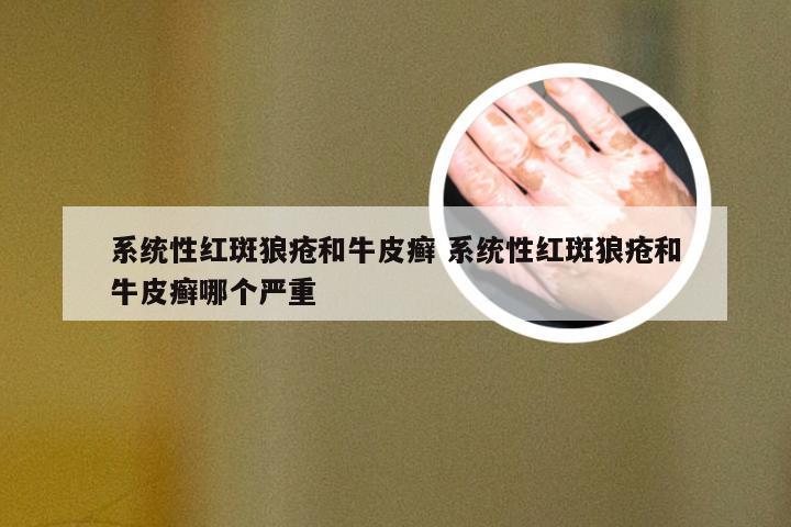 系统性红斑狼疮和牛皮癣 系统性红斑狼疮和牛皮癣哪个严重