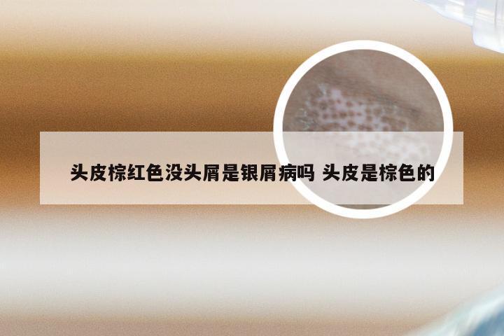 头皮棕红色没头屑是银屑病吗 头皮是棕色的