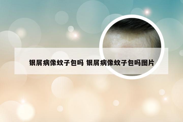 银屑病像蚊子包吗 银屑病像蚊子包吗图片