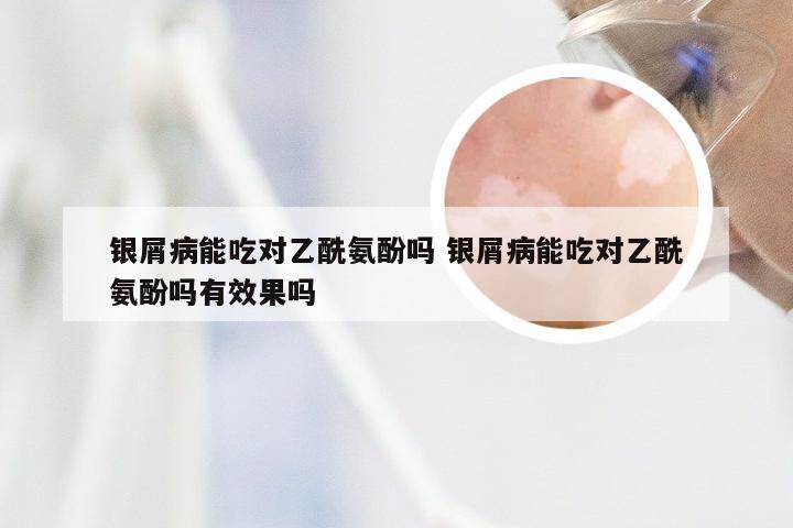银屑病能吃对乙酰氨酚吗 银屑病能吃对乙酰氨酚吗有效果吗