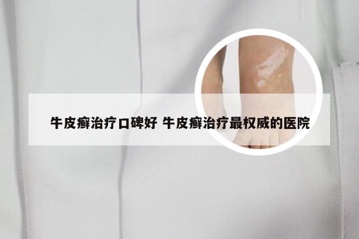 牛皮癣治疗口碑好 牛皮癣治疗最权威的医院