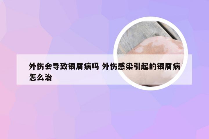 外伤会导致银屑病吗 外伤感染引起的银屑病怎么治