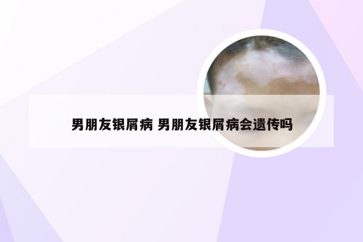 男朋友银屑病 男朋友银屑病会遗传吗