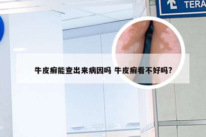 牛皮癣能查出来病因吗 牛皮癣看不好吗?