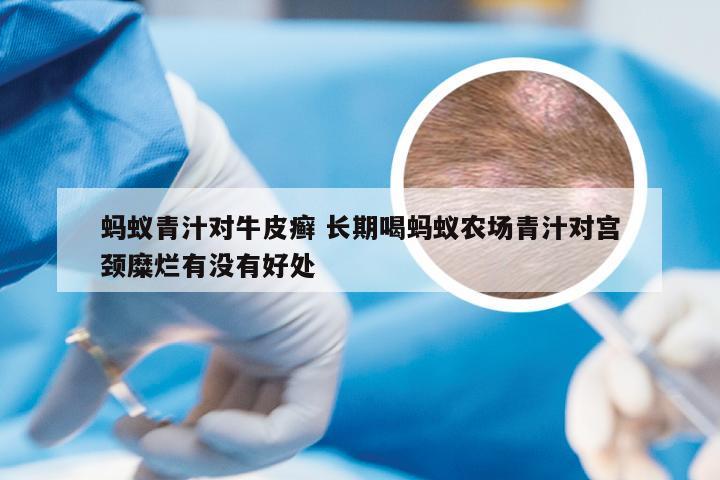 蚂蚁青汁对牛皮癣 长期喝蚂蚁农场青汁对宫颈糜烂有没有好处