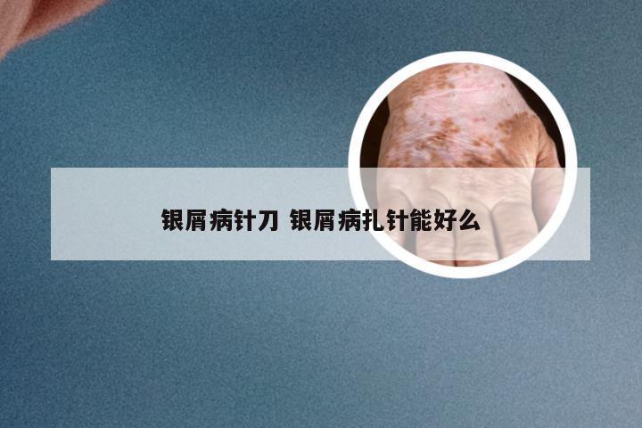 银屑病针刀 银屑病扎针能好么