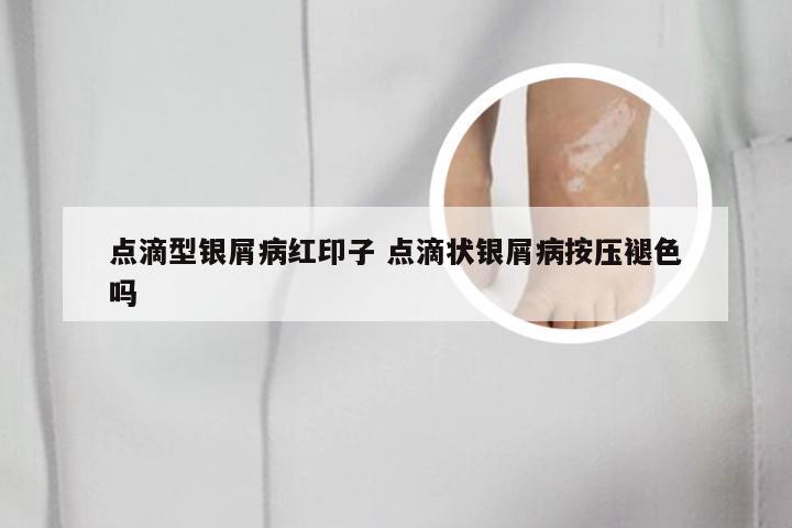 点滴型银屑病红印子 点滴状银屑病按压褪色吗