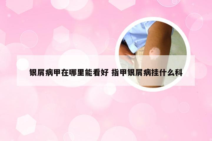 银屑病甲在哪里能看好 指甲银屑病挂什么科