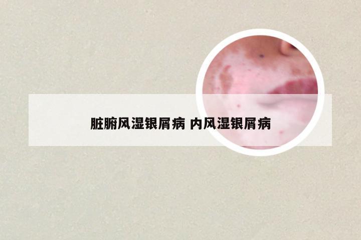 脏腑风湿银屑病 内风湿银屑病