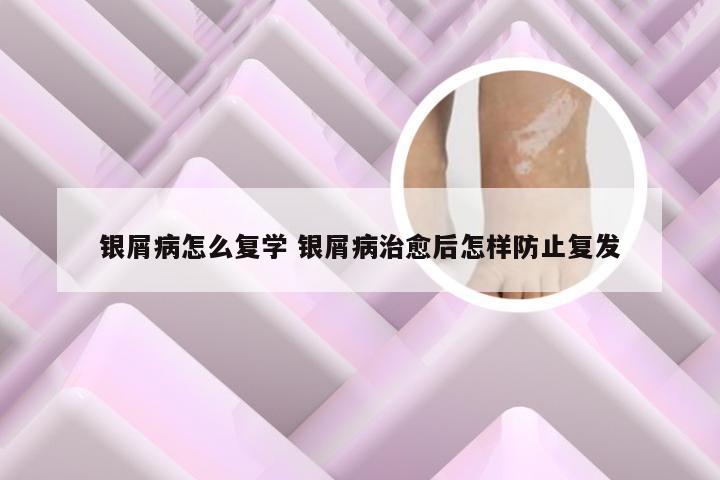 银屑病怎么复学 银屑病治愈后怎样防止复发