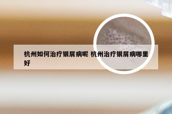 杭州如何治疗银屑病呢 杭州治疗银屑病哪里好