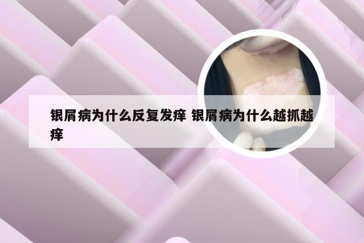 银屑病为什么反复发痒 银屑病为什么越抓越痒