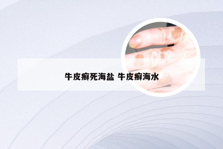 牛皮癣死海盐 牛皮癣海水