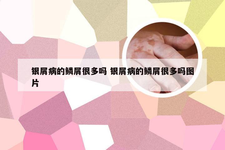银屑病的鳞屑很多吗 银屑病的鳞屑很多吗图片