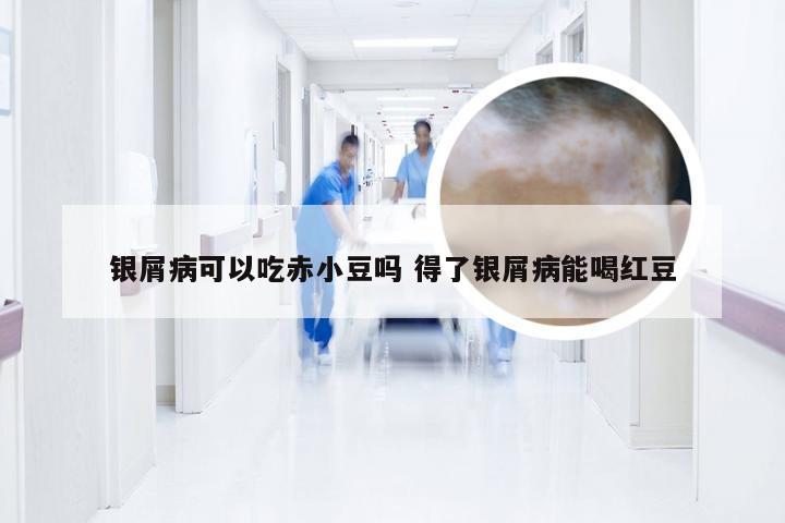 银屑病可以吃赤小豆吗 得了银屑病能喝红豆