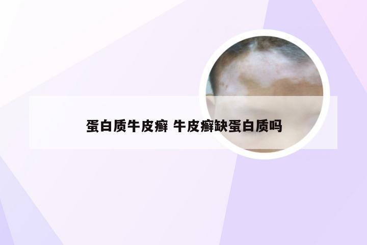 蛋白质牛皮癣 牛皮癣缺蛋白质吗