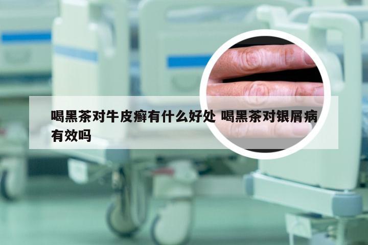 喝黑茶对牛皮癣有什么好处 喝黑茶对银屑病有效吗