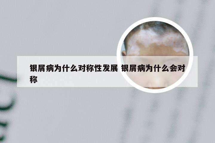 银屑病为什么对称性发展 银屑病为什么会对称