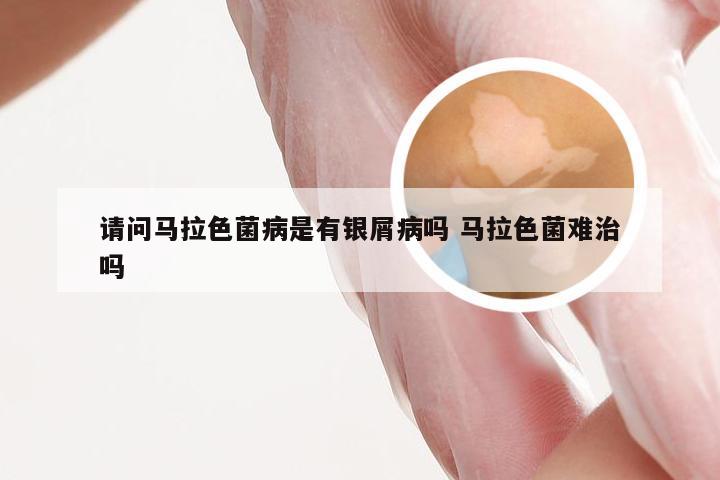请问马拉色菌病是有银屑病吗 马拉色菌难治吗